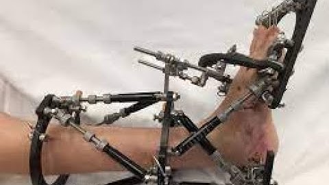 Application Bone Fixation Device CPT code - simplify medical coding