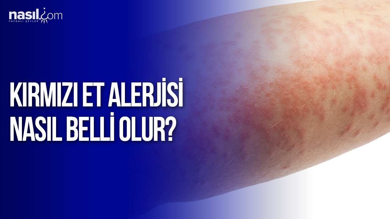 Kirmizi Et Alerjisi Nasil Belli Olur