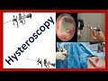 Hysteroscopy procedure indications contraindications and complications