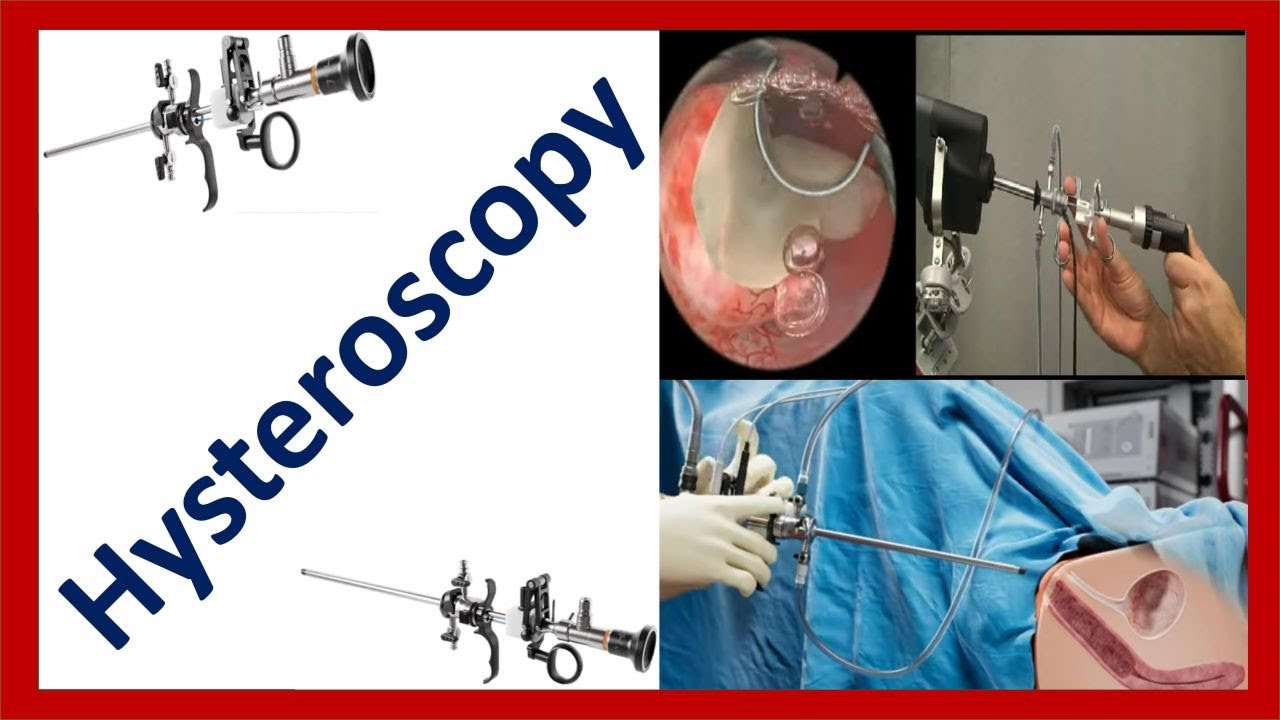Hysteroscopy Procedure Indications Contraindications And Hysteroscopy Procedure Indications Contraindications And