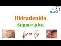 Hidradenitis Suppurativa (HS) | Pathophysiology, Triggers, Signs & Symptoms, Diagnosis, Treatment