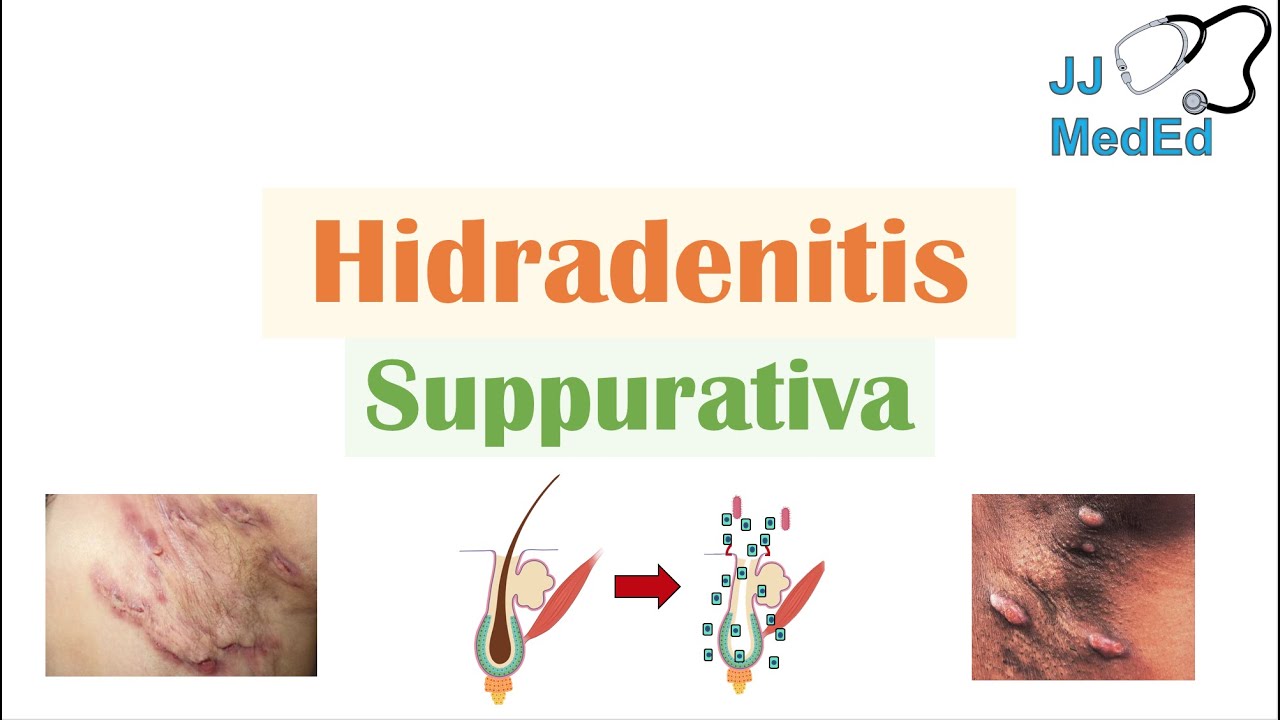 Hidradenitis Suppurativa (HS) Pathophysiology, Triggers