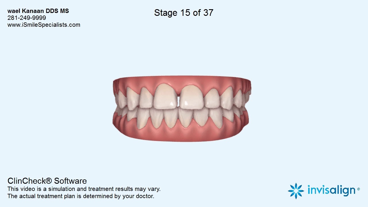 Palatal Expander Gap Front Teeth