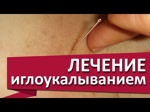 Иглоукалывание. ✹ Снять боль в желудке поможет иглоукалывание. МДЦ ОЛИМП