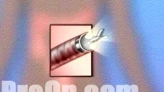 PreOp® Patient Education Endoscopy of Large Intestine 2