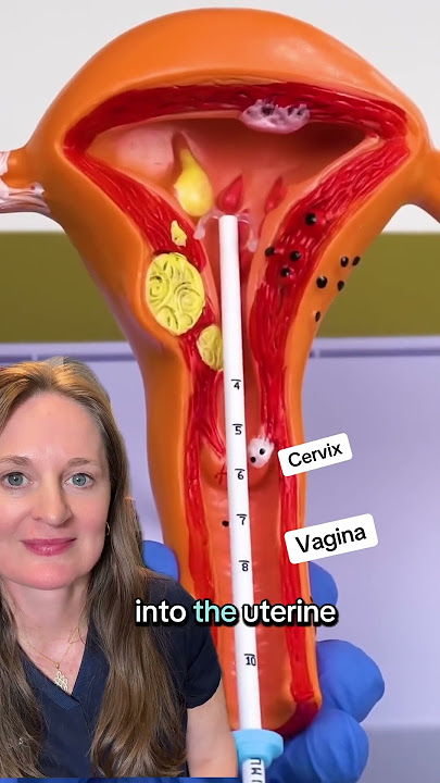Did you learn something? #iud