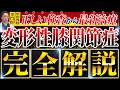 【変形性膝関節症】変形性膝関節症の診断と治療を完全解説