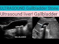 Ultrasound liver! Gallbladder Stone! Ultrasound abdomen showing Cholelithiasis!#ultrasoundmadeeasy86
