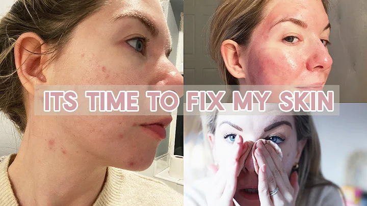 ITS TIME TO FIX MY SKIN | MY ACNE AND SCARRING JOU...