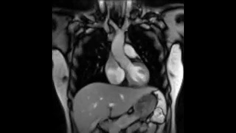 Real-time MRI of a human heart