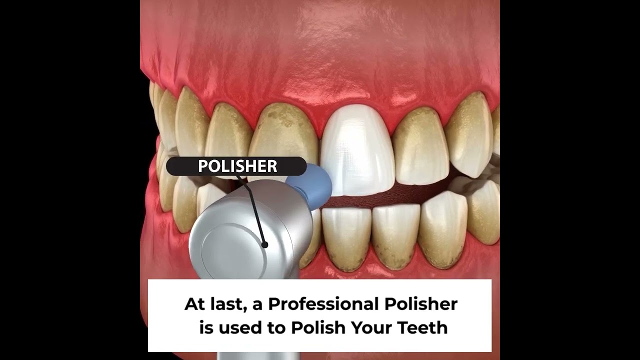 How to get Professional Teeth Cleaning at Sabka Dentist Dental Clinic