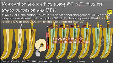 New broken file removal technique with new files/新開発のファイルを使った新たな破折器具の除去方法