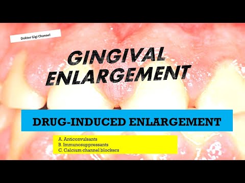 Part 2 | Pembesaran Gingiva yang Diinduksi oleh obat Drug Induced Gingival Enlargement