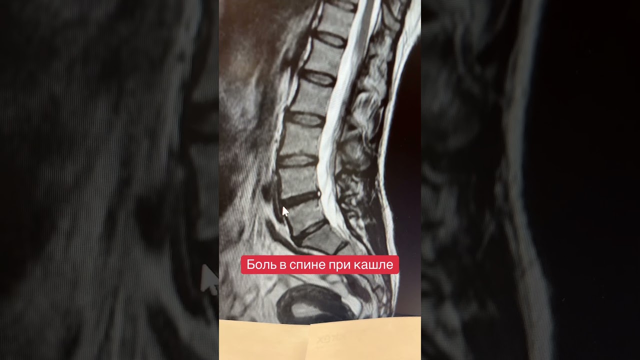 Боль в спине при кашле