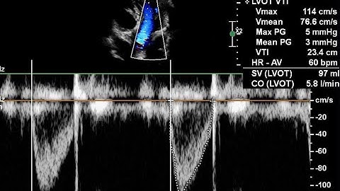 Hướng dẫn cách đo cung lượng tim qua siêu âm tim