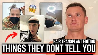 The WORST things about HAIR TRANSPLANT SURGERY - Philip Green