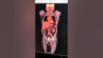 Whole Body PET Scan (positron emission tomography)