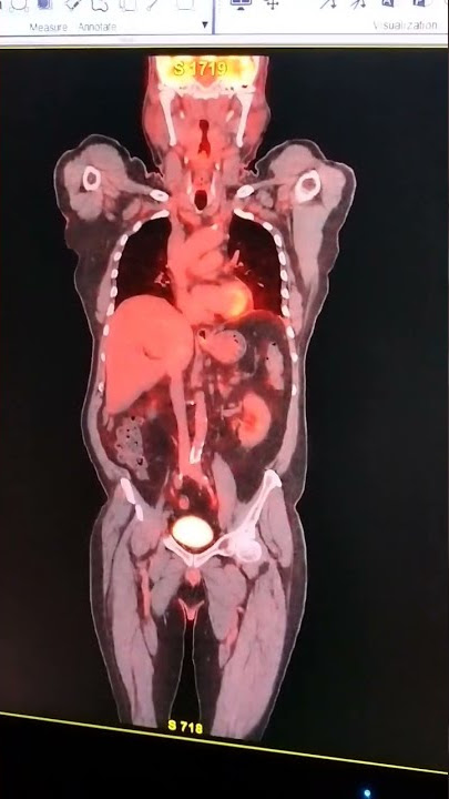 Whole Body PET Scan (positron emission tomography)