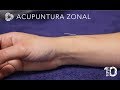 Acupuntura zonal