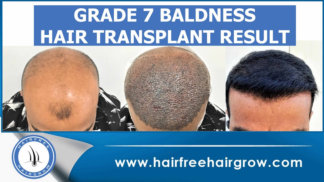 Hair Transplant In Surat  Hairfree And Hairgrow Clinic  Hair  Transplantation Clinic in Surat