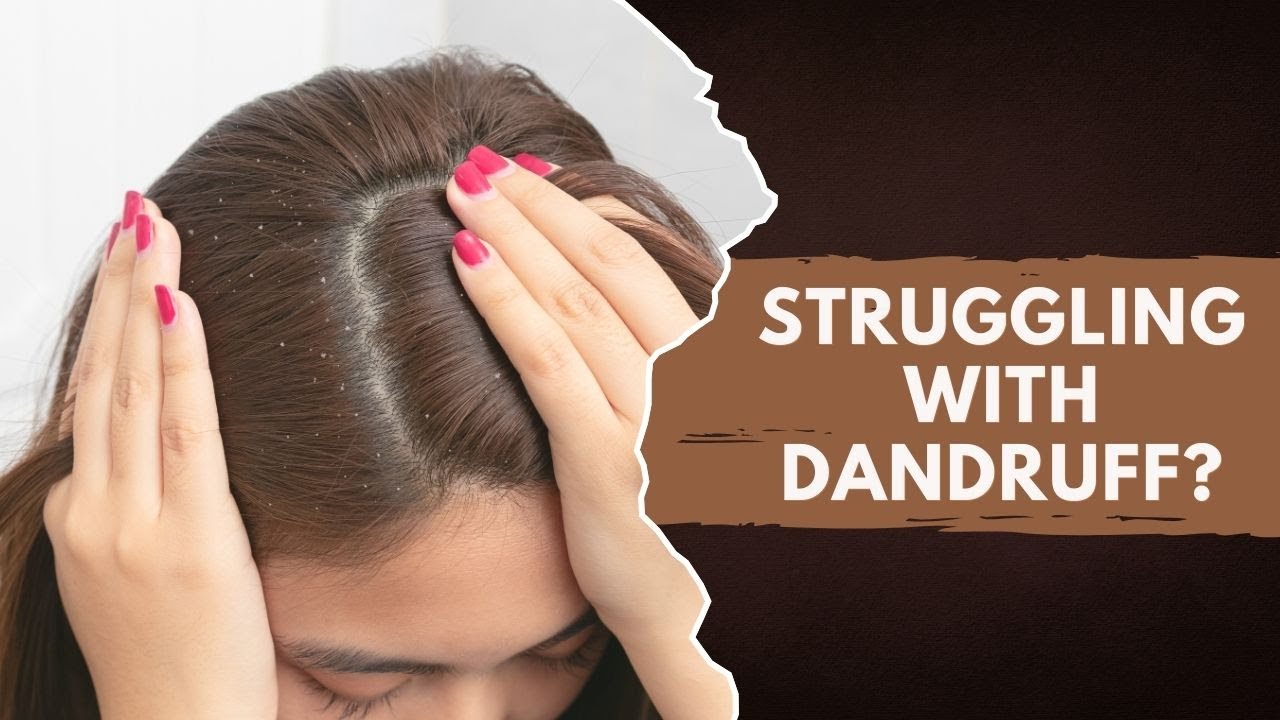 Itchy Scalp & Dandruff? 5 Best Supplements for Seborrheic Dermatitis Relief