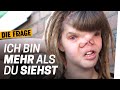 Body Acceptance: Meine Narben gehören zu mir | Wie lebe ich mit einer schweren Krankheit? Folge 4