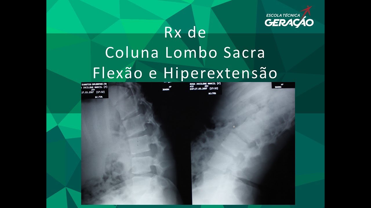 Coluna Lombo Sacra Flexão e Hiperextensão, image size:1280x720