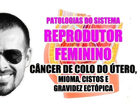 Vídeo: Tumores Malignos Do Sistema Reprodutor Feminino