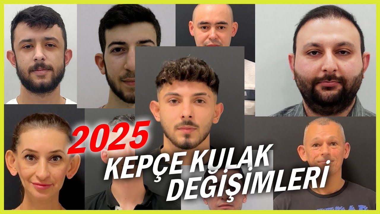 Kepçe Kulak Ameliyatı Öncesi Sonrası - 2025
