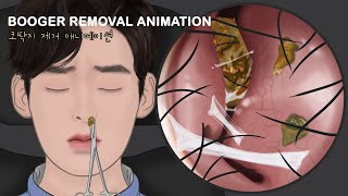 ASMR Endoscopic Nose Secretion Removal Animation / Piercing nose full of boogers!