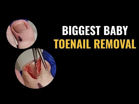 biggest-baby-toenail-removal