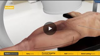Trochanteric Nail surgical animation | Gamma4 Hip Fracture Nailing System
