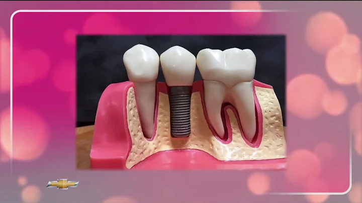 What are Teeth Implants? - The Art of Dentistry - ...