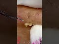 blackhead removal from nose/ old aged blackheads removal