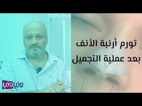 تورم أرنبة الأنف بعد عملية التجميل