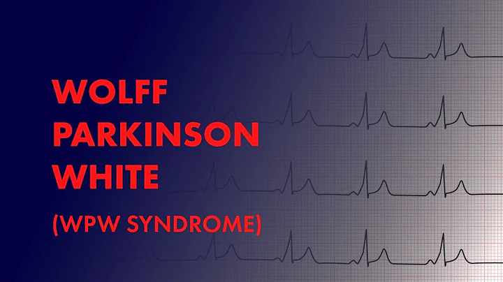 Wolff Parkinson White (WPW Syndrome) -  EKG (ECG) Interpretation