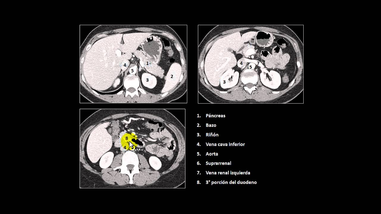 Indefinido Refinería Dependiente tac de abdomen anatomia De tormenta comida Cálculo Indefinido Refinería Dependiente tac de abdomen anatomia De tormenta comida Cálculo