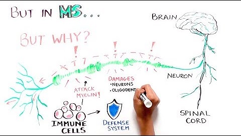 Progress and Promise of Stem Cell Research: Multiple Sclerosis