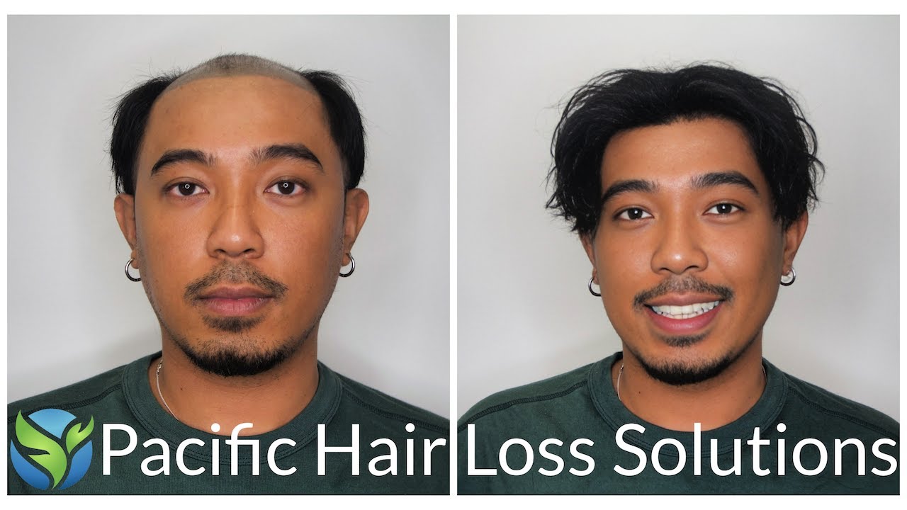 Life-changing men's hairpiece system adhesive install before & after | Pacific Hair Loss Solutions