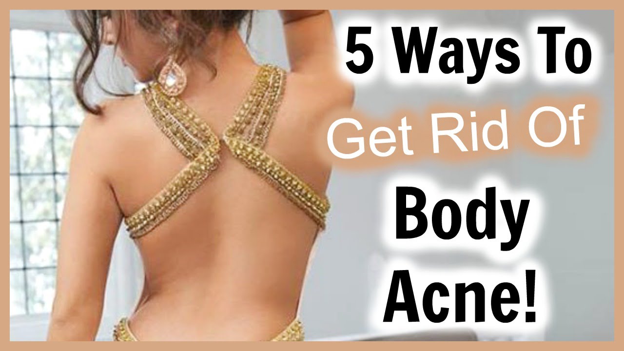 5 Ways to Get Rid of Back Acne! │ How to Get RID of Body Acne and