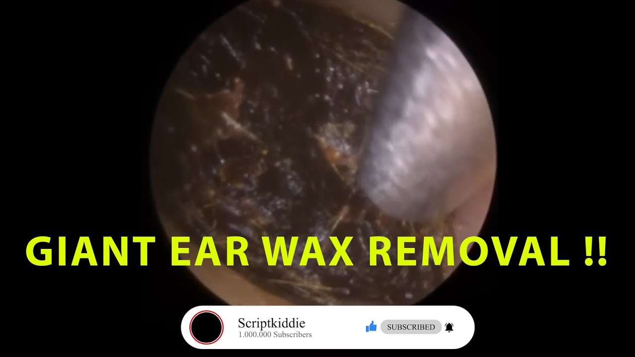 BIG GIANT EAR WAX REMOVAL !! YouTube
