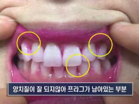 양치질습관테스트최종