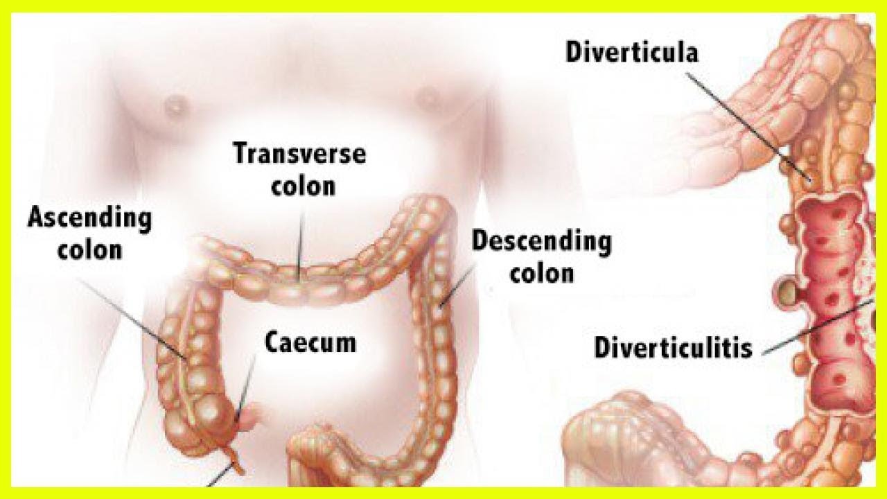 Sintomas diverticulos en el colon