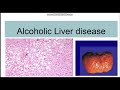 Alcoholic Liver Disease : Spectrum, Morphology and Pathophysiology