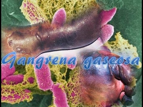 Vídeo: Gangrena Gaseosa: Síntomas, Formas De Infección, Tratamiento