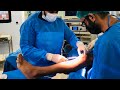 Taking Peroneus Longus Tendon for #ACL graft for #aclreconstruction #aclgraft