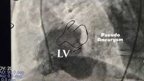 DrRaviRT - Large LV Pseudoaneurysm Device Closure