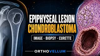Chondroblastoma — The Epiphyseal Lesion in the Young