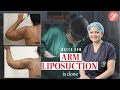 ARM LIPOSUCTION before and after | Watch how Arm Liposuction is done (Full Procedure) | Arm Lipo