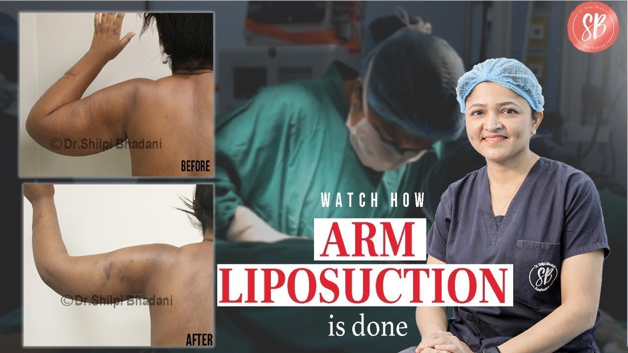 ARM LIPOSUCTION before and after | Watch how Arm Liposuction is done